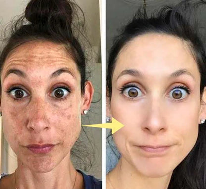 ✨Last Day Discount: 87%OFF-NESLEMY™  Remove freckle Facial Serum