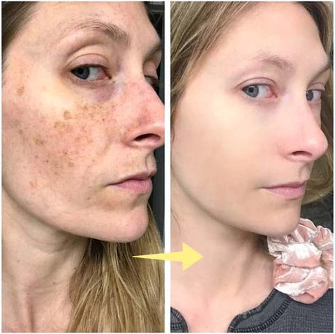 ✨Last Day Discount: 87%OFF-NESLEMY™  Remove freckle Facial Serum