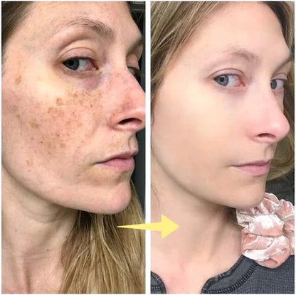 ✨Last Day Discount: 87%OFF-NESLEMY™  Remove freckle Facial Serum